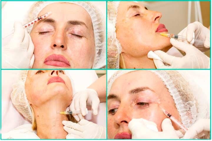 Контурная пластика лица филерами