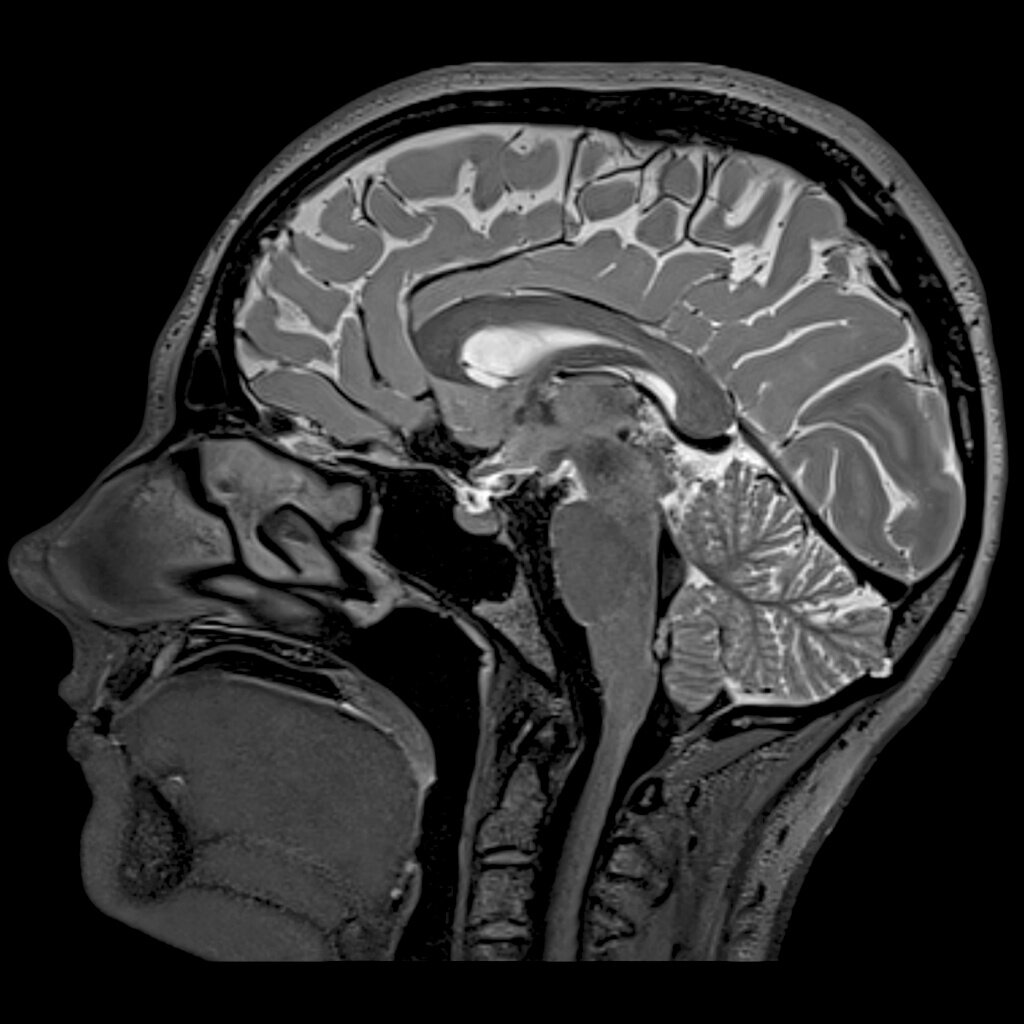 Что показывает МРТ головного мозга | Общегородской центр записи | Дзен