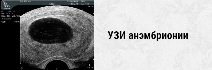 не развивающая беременность. анэмбриония – замершая беременность. узи снимок при анембрении. узи анэмбриония 5 недель. узи 8 недель беременности анэмбриония.