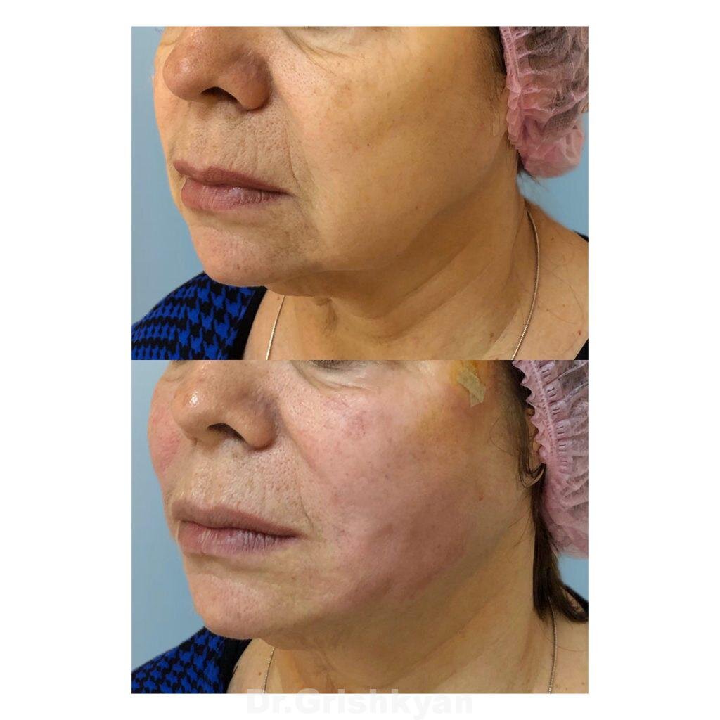 Пример подтяжки нитями до и после. Фото с сайта Д.Р. Гришкяна. Имеются противопоказания, требуется консультация специалиста