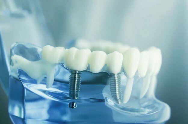 Что значит имплантация зубов «под ключ»? | Стоматология ROOTT | Дзен