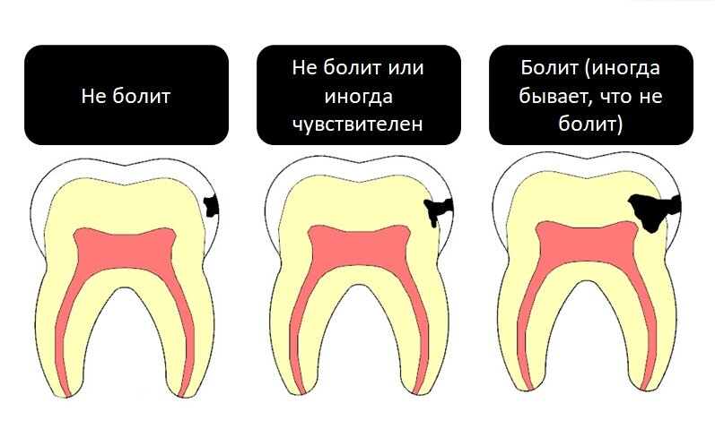 Развитие поражения зуба (кариес) с течением времени