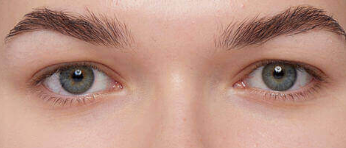 Обычное веко и нависшее. Сравнение нависшего века и обычного. Сравнение нависшего века и обычного. Обычное веко и нависшее. Нависшее веко и обычное сравнение.