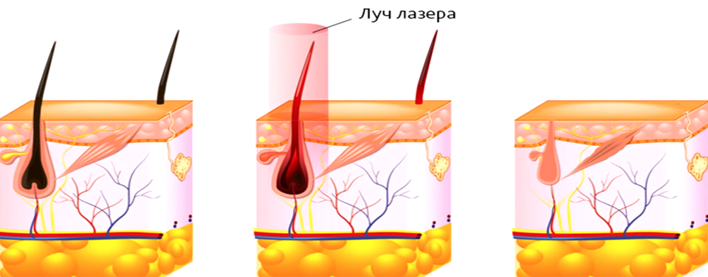 Лазерная эпиляция схема процедур