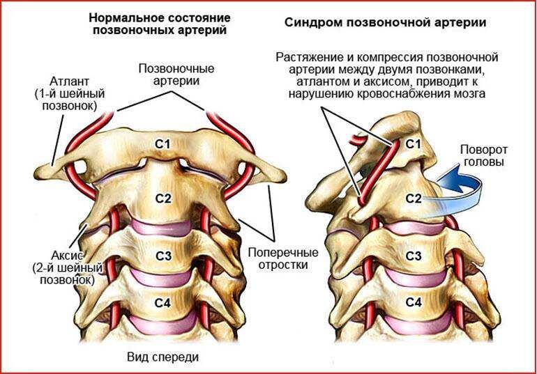 Что значит гипоплазия позвоночной артерии