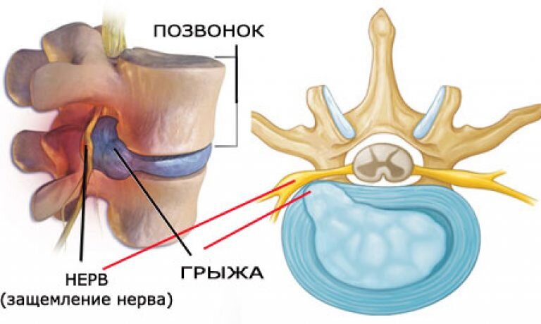 Грыжа позвоночника что это такое