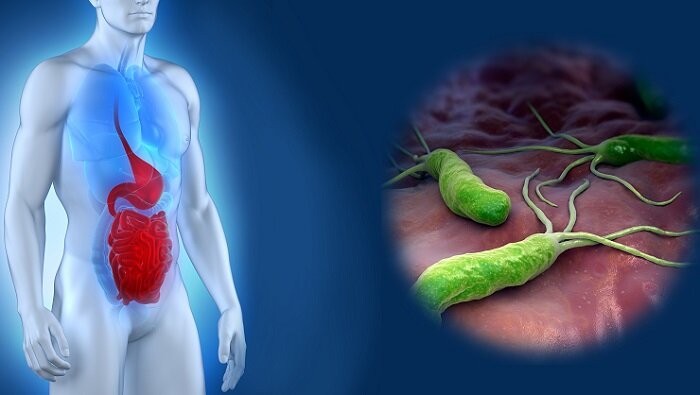 язва 12 перстной кишки