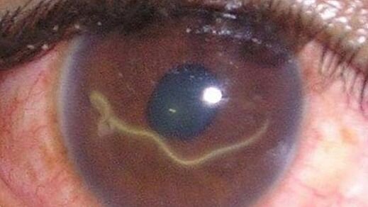 
Это червь типа нематоды, известный под именем "лоа-лоа". Этот паразит вызывает у хозяина глазные или кожные заболевания. Проникнув в организм, червь путешествует по всей подкожной ткани человека. Проникнув внутрь, они доставляют неудобства хозяину, в основном делая болезненным процесс зрения. В основном паразиты обитают в Африке.