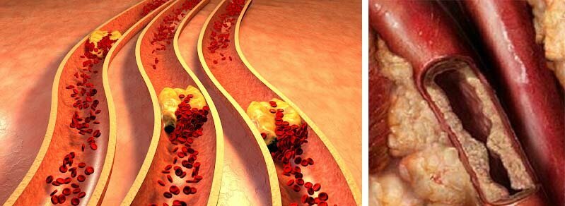 Sipas Organizatës Botërore të Shëndetit (OBSH), bllokimi vaskular është përgjegjës për deri në 93% të sëmundjeve, nga sëmundjet e traktit gastrointestinal deri në dëmtimin e shikimit.