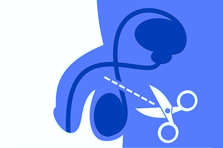 Другими словами - мужская стерилизация.  Операция ,при которой происходит иссечение фрагмента семявыносящего протока либо его клепирование или перевязка.