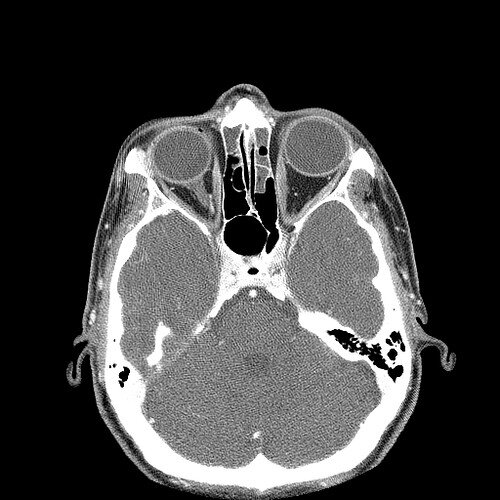 КТ орбит и глаза