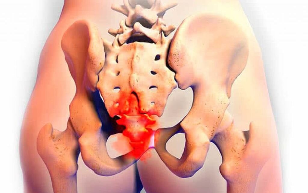 Боли под попой. Крестцово поясничный отдел Кобчик.