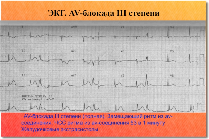 Блокады на экг. ЭКГ при АВ блокаде 3 степени. ЧСС при АВ блокаде 3 степени. АВ блокада 3 степени ритм. Ритм при АВ блокаде 1 степени.