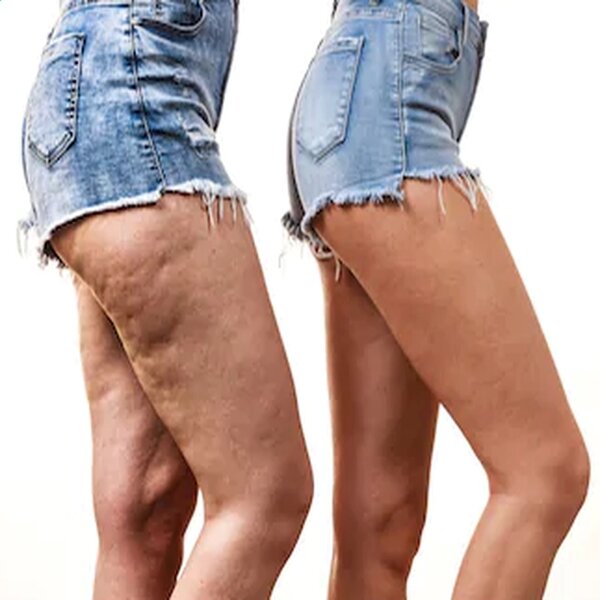https://image.shutterstock.com/image-photo/comparison-female-legs-thighs-without-260nw-773387890.jpg