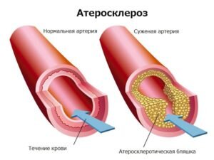 [caption id="attachment_771" align="aligncenter" width="300"] Так выглядит закупорка сосудов[/caption]