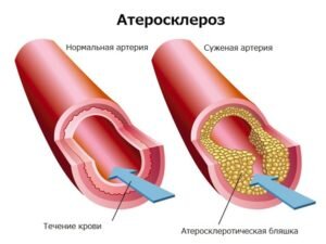 Если диагноз атеросклероз сосудов головного мозга