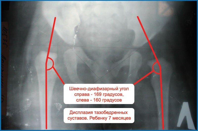 Бедренный угол. Дисплазия тазобедренного сустава 2 а. Рентгенологический симптом дисплазии тазобедренных суставов. Дисплазия тазобедренных суставов рентген.