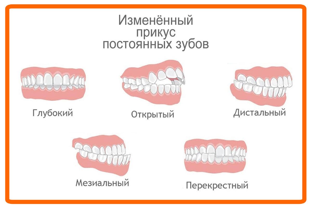 Правильный прикус и неправильный прикус картинки