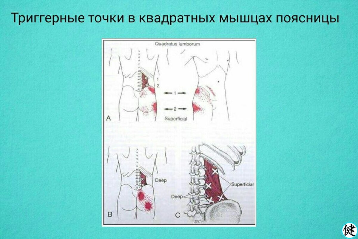 Триггерные точки в средней ягодичной мышце | Здоровье с нами | Дзен