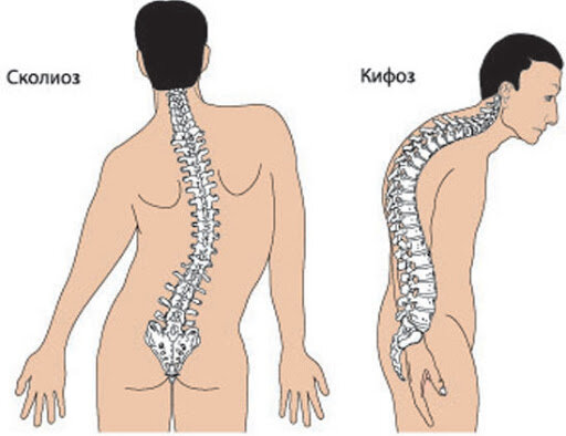 Лечение кифосколиоза грудного отдела позвоночника без операций