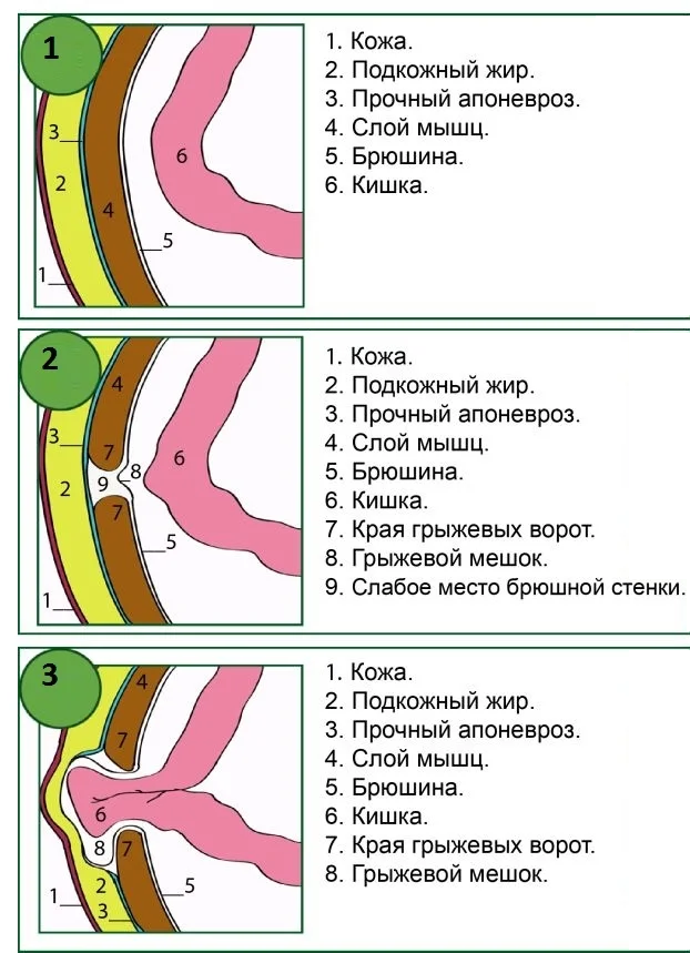 Пупочная грыжа у новорожденных младенцев и у грудничка: лечение, симптомы, фото