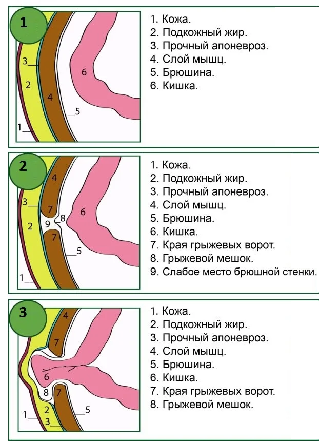 Пупочная грыжа у детей: рекомендации врачей и современные методы лечения