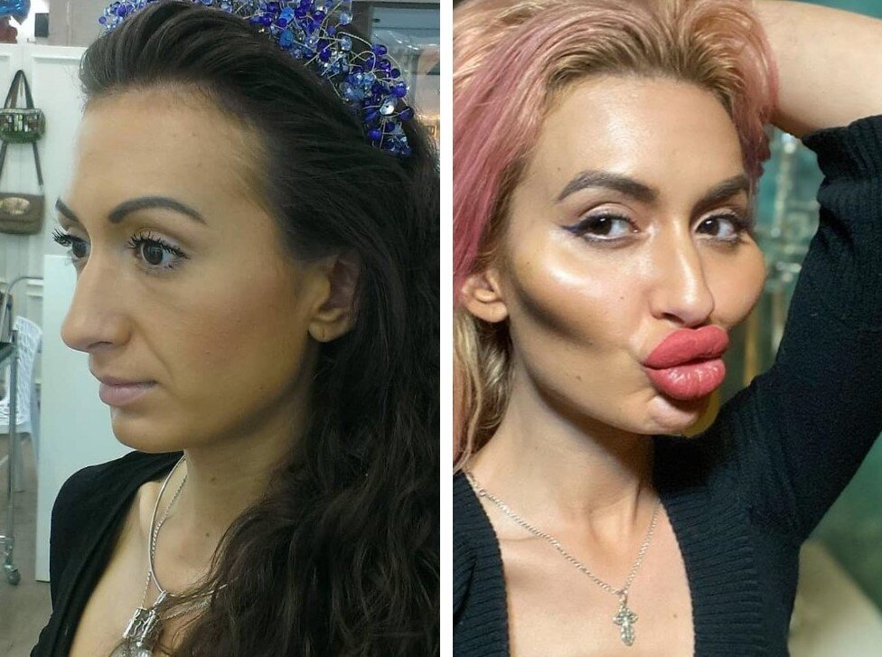 Miravi фото до пластики Как выглядела Анастасия Покрещук до пластики Незабудка Дзен
