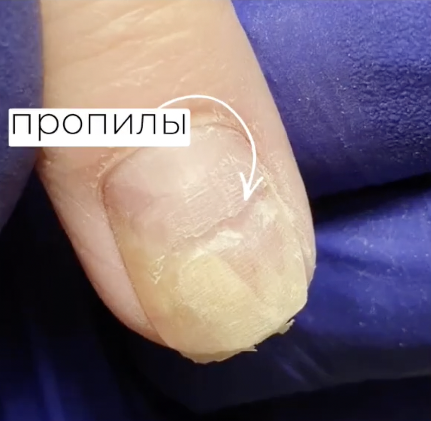 Лечение вросшего ногтя: дома или у хирурга?