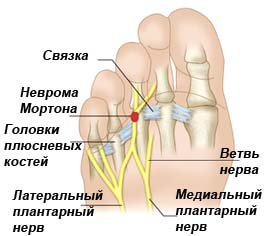 Невринома мортона стопы что это. Межпальцевая неврома Мортона. Невринома Мортона стопы операция. УЗИ стопы неврома Мортона.