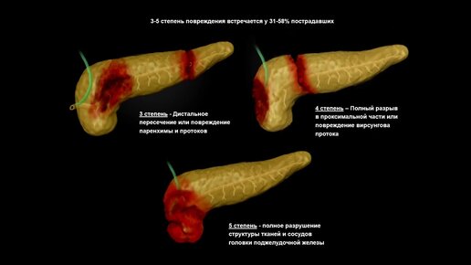 Инволютивные изменения поджелудочной железы