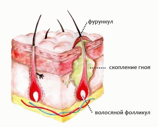 Фурункул. Рисунок: getty images