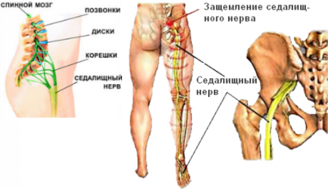 Как снять боль при защемлении седалищного нерва?