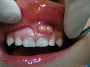 Зубной флюс и его лечение