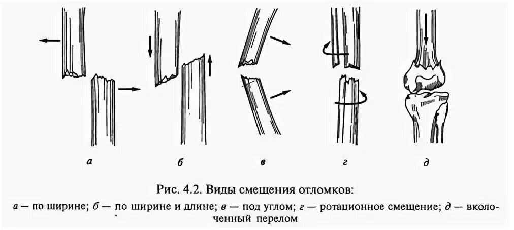 Смещение отломков по ширине. Продольное смещение костных отломков. Перелом кости со смещением отломков. Со смещением костных отломков. Диафизарные переломы бедренной кости.