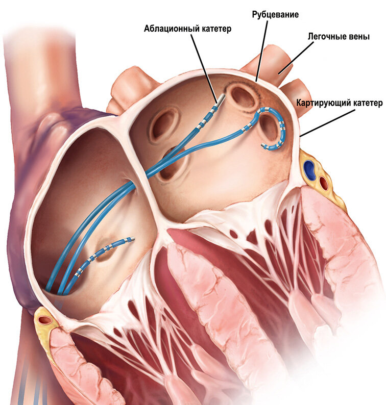 Радиочастотная аблация сердца