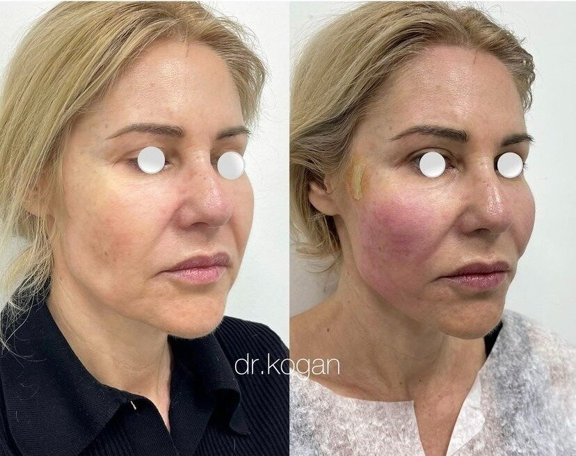 Подтяжка лица нитями APTOS фото до и после. Фото с сайта Д.Р. Гришкяна. Имеются противопоказания, требуется консультация специалиста