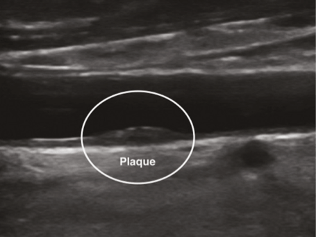 Так выглядит УЗ-картина атеросклеротической бляшки в просвете артерии