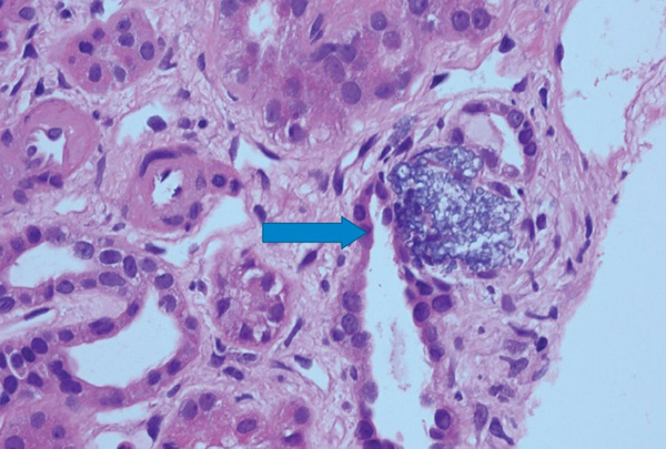 На снимке видны микрокальцификации - образования из-за отравления витамином D