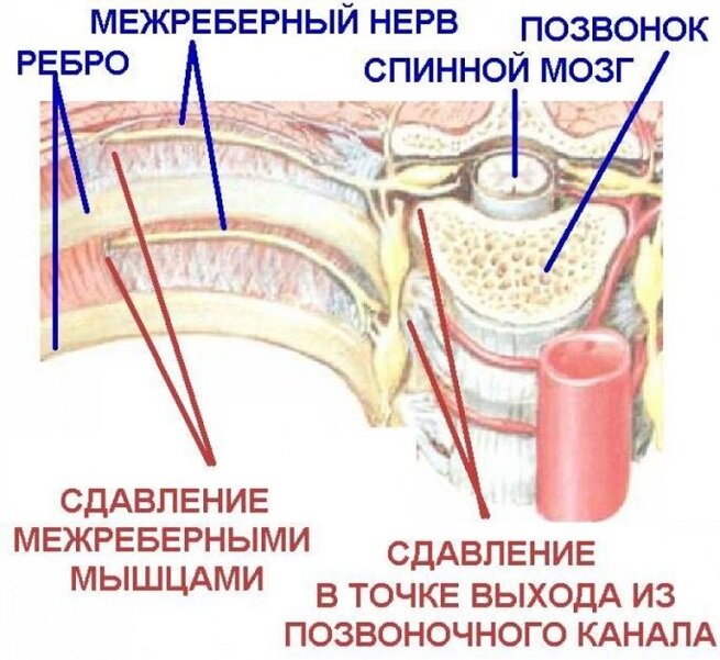 Лечение межребеной невралгии в Минске - Снять спазм и убрать боль