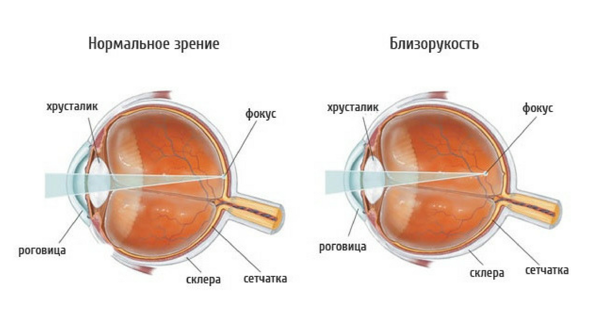 Строение глаза при миопии высокой степени. Дальнозоркость и близорукость строение глаза. Сложный гиперметропический астигматизм 1 степени.