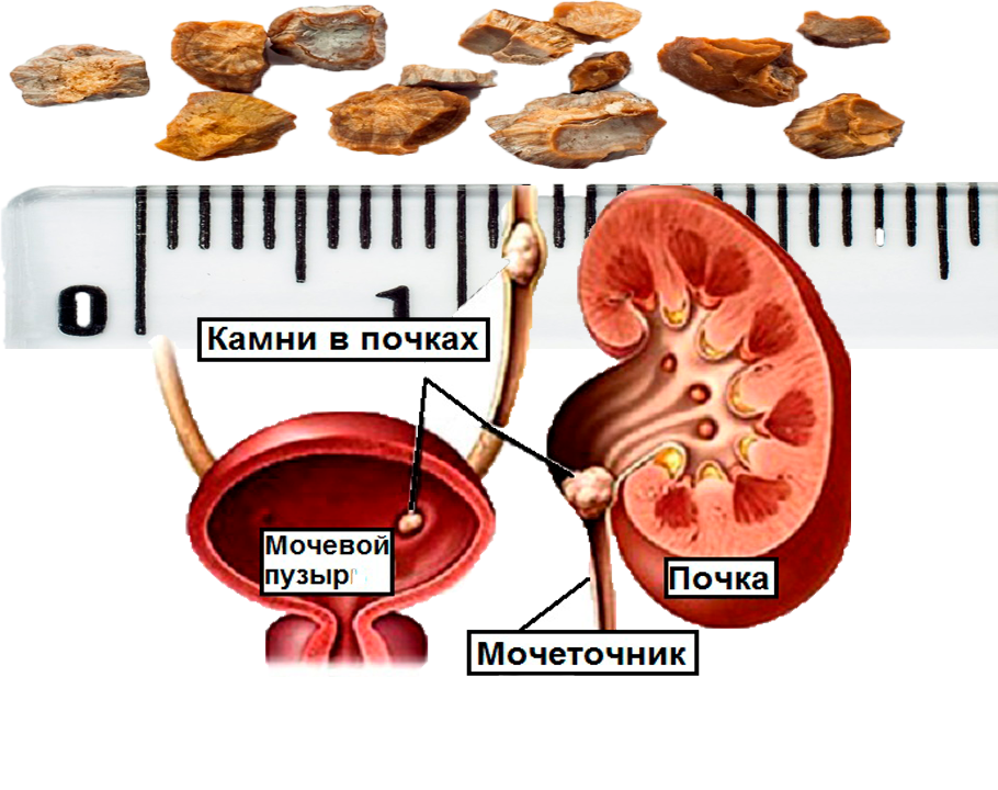 Камни вышли из почек. Выведение почечных камней. Как выводятся камни из почек.