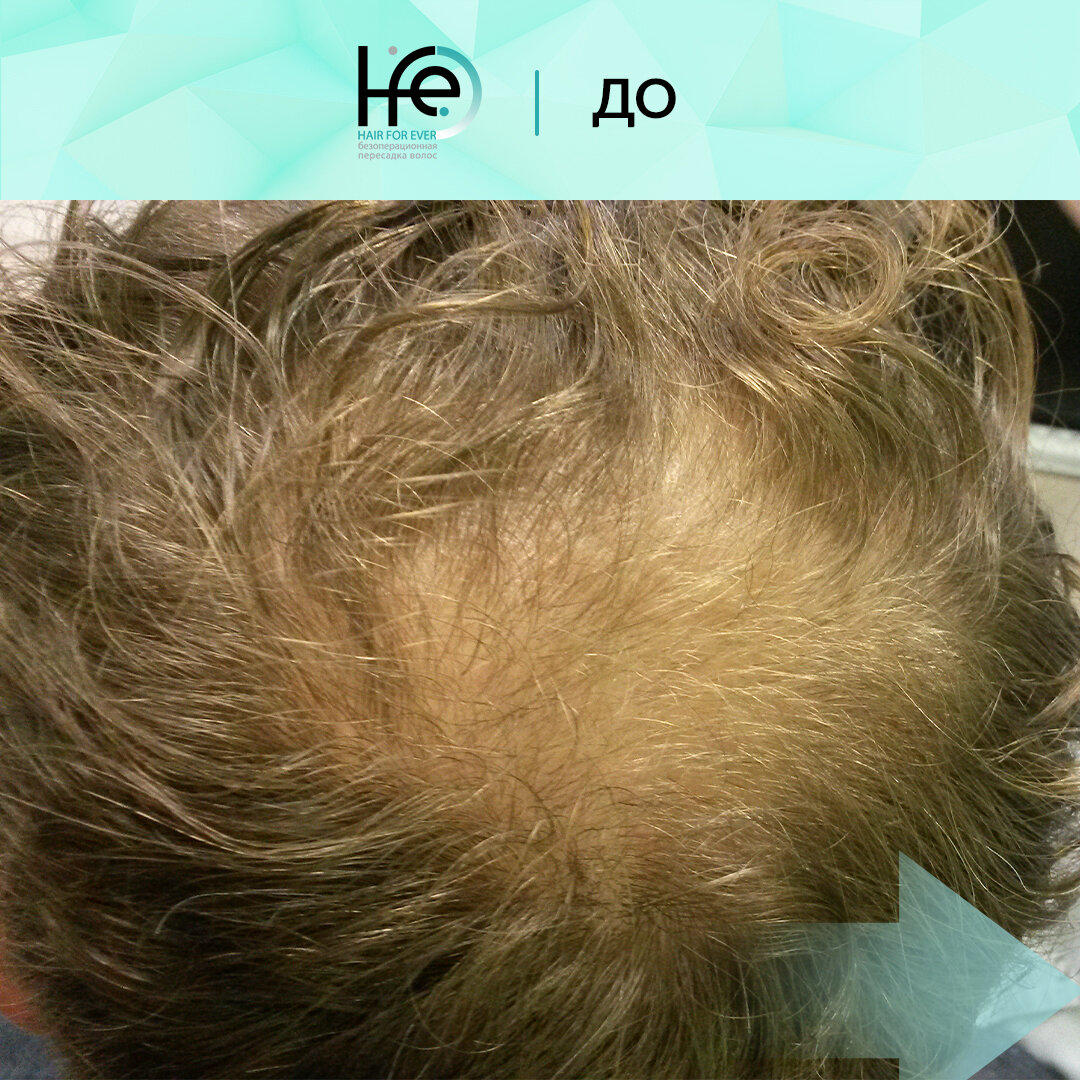 Пересадка волос в санкт петербурге. Клиника ХФЕ пересадка волос. Пересадка волос в Костроме. Бебур до пересадки волос и после. Пересадка волос до и после.