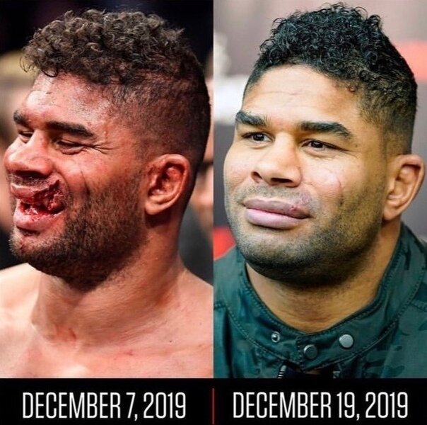 Экс-претендент на титул UFC в тяжелом весе (до 120 кг), голландский ветеран Алистар Оверим (45-18) сообщил в своем Instagram, что получил разрешение драться.  
Напомним, в своем крайнем бою на турнире UFC on ESPN 7 в начале декабря Оверим уступил нокаутом в 5-ом раунде суринамскому проспекту Жаирзиньо Розенштруйку (9-0) и получил очень сильное рассечение губы, потребовавшее пластической операции. 

"UFC всегда заботится о своих бойцах, особенно если вы получили травму в бою. Благодаря медицинской команде UFC меня сразу же после турнира доставили в больницу, где пластический хирург позаботился о моей ране. Потрясающий результат. И... мне снова разрешено драться. Не могу дождаться, чтобы вернуться в октагон", - написал Оверим.