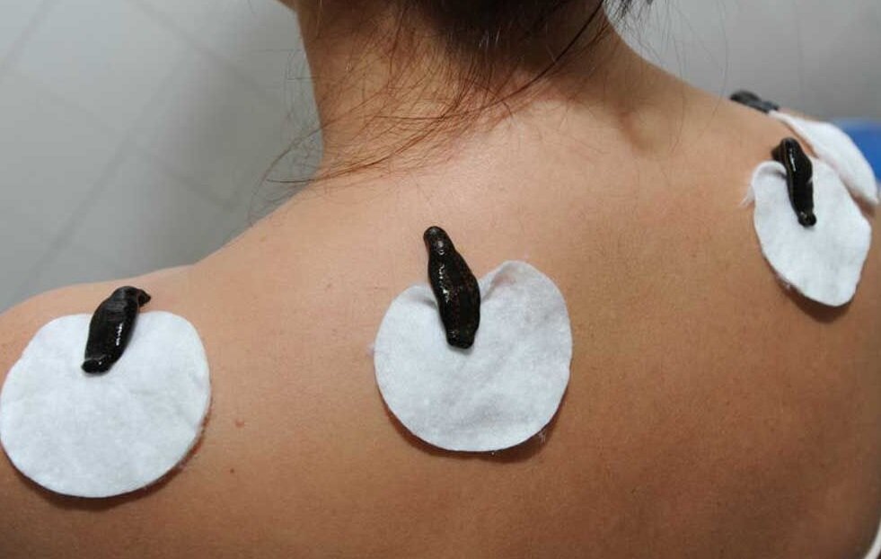 фото взято из открытых источников, гирудотерапия