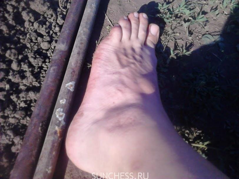 Опухший голеностоп — результат несоблюдения техники безопасности при тренировке «Стройная фигура за 30 дней»