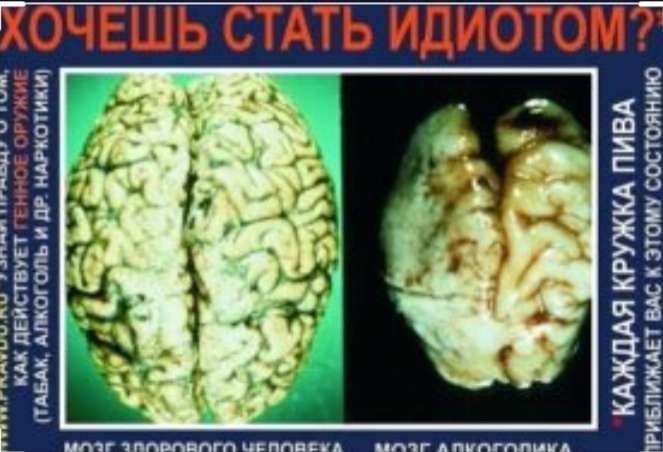 Мозг здорового человека и мозг алкоголика.