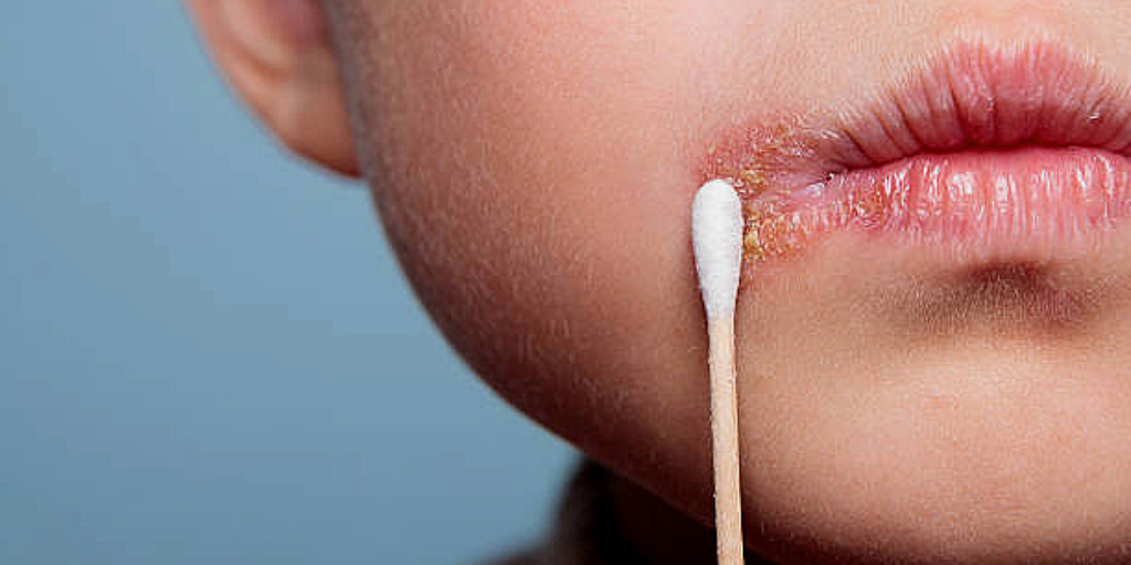 О чем говорят трещинки в уголках губ, и как от них избавиться