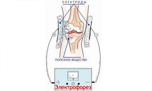 Электрофорез (ионофорез) и гальванизация