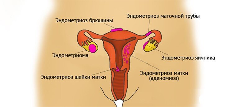 В случае эндометриоза шейки матки, эндометриальная ткань становится ненормально утолщенной и начинает расти в других участках шейки матки. Это может привести к различным симптомам, таким как боли внизу живота, неправильные менструации или кровянистые выделения вне периода менструации. У женщин с эндометриозом шейки матки также может наблюдаться изменение цвета шейки матки и наличие кист и полипов.