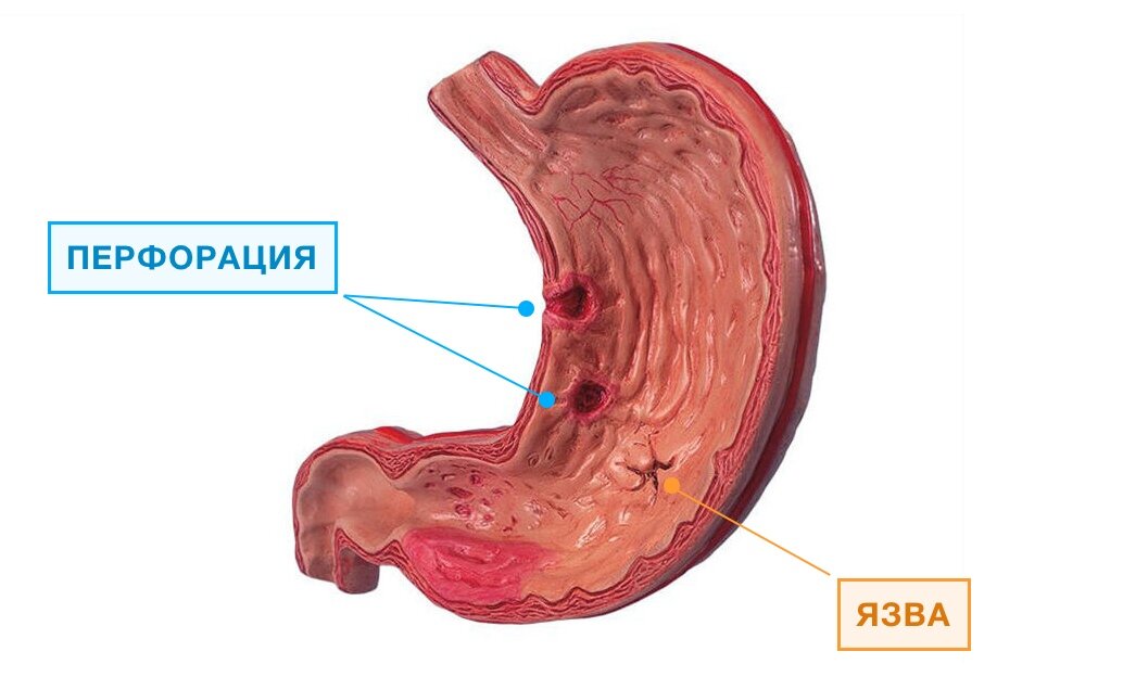 В тандеме гастрит и язва повышают риск онкологии брюшной полости.
